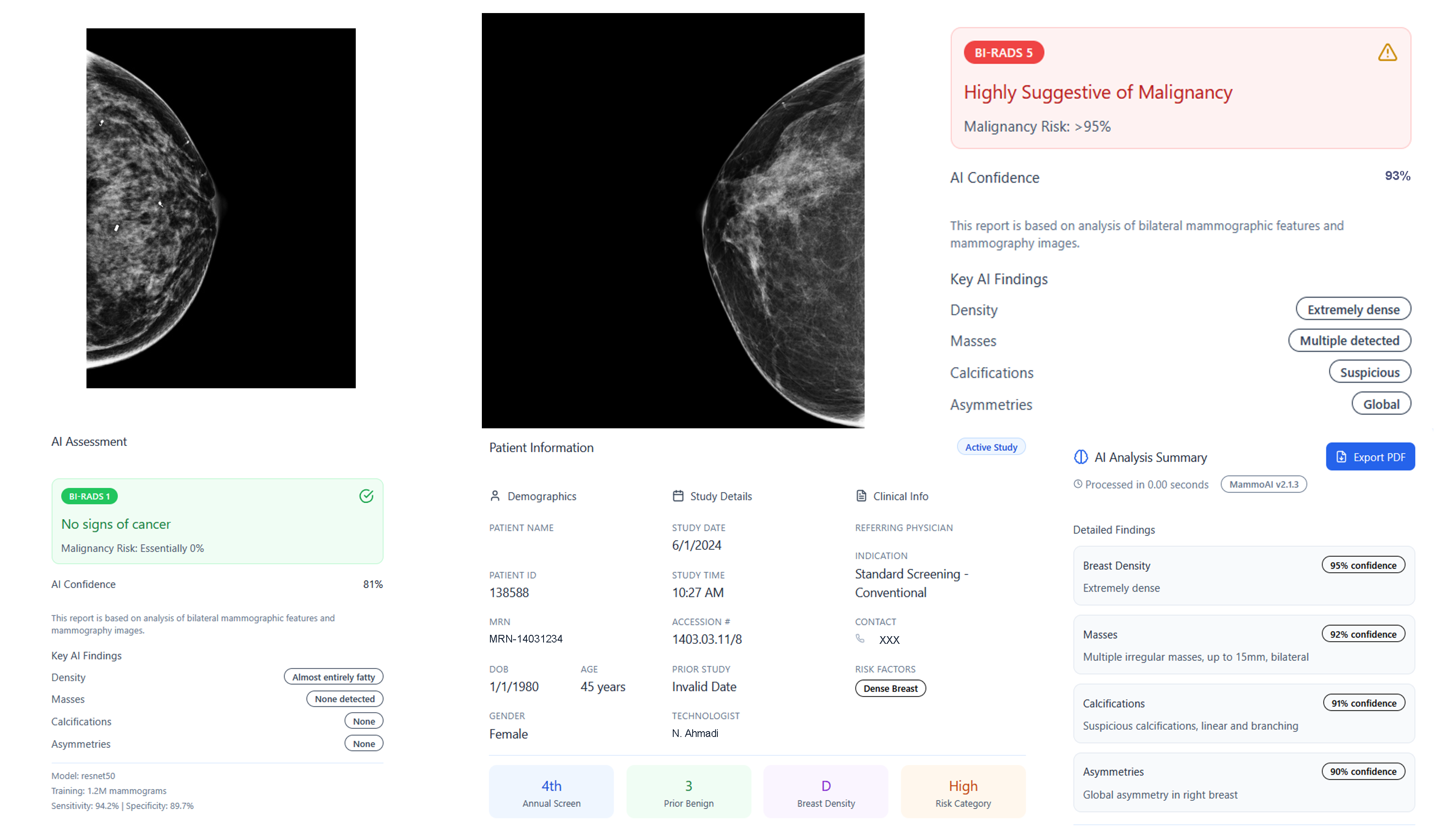 AI-based mammography report showing cancer risk assessment with BI-RADS classification